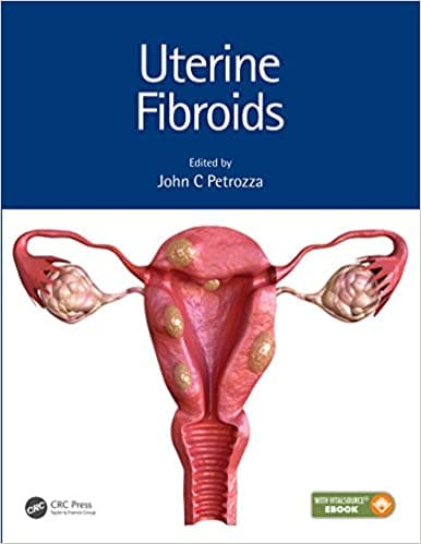Uterine Fibroids 2021 By John C. Petrozza