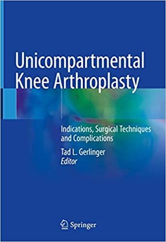 Unicompartmental Knee Arthroplasty: Indications, Surgical Techniques and Complications 2019 by Tad L. Gerlinger