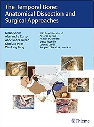The Temporal Bone Anatomical Dissection And Surgical Approaches 2018 by M Sanna