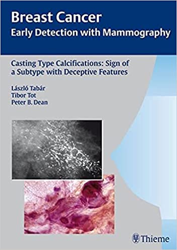 Casting Type Calcifications Sign Of A Subtype With By Tabar