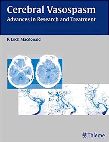 Cerebral Vasospasm By Macdonald