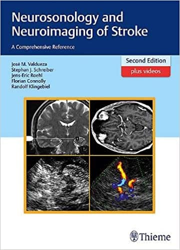 Neurosonology And Neuroimaging Of Stroke 2Nd Edition By Valdueza et al
