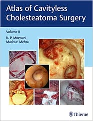 Atlas Of Cavityless Cholesteatoma Surgery (Volume 2) By Morwani