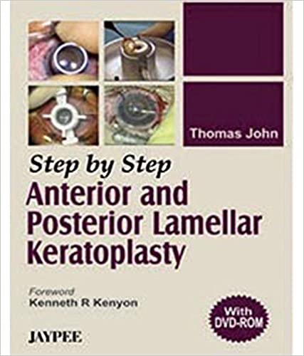 Step By Step Anterior And Posterior Lamellar Keratoplasty With Dvd 1st Edition By John