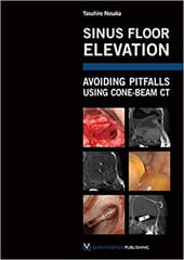 Sinus Floor Elevation: Avoiding Pitfalls Using Cone-Beam CT  2010 By Nosaka Publisher Quintessence Publishing