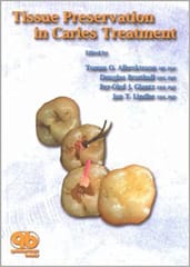 Tissue Preservation in Caries Treatment  2001 By Alberktsson Publisher Quintessence Publishing