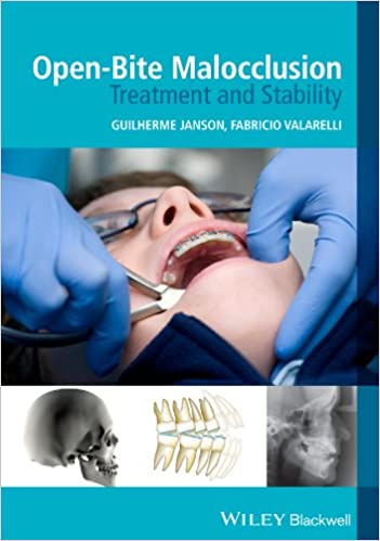 Open Bite Malocclusion: Treatment & Stabiligy 2014 By Janson Publisher Wiley