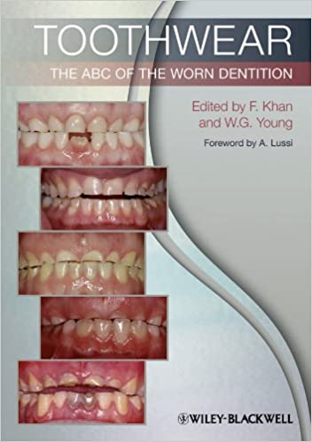 Toothwear: The ABC of the Worn Dentition 2011 By Khan Publisher Wiley