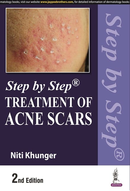 Step by Step Treatment of Acne Scars 2nd Edition 2022 By Niti Khunger