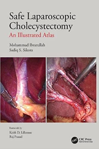 Safe Laparoscopic Cholecystectomy An Illustrated Atlas 2022 By Ibrarullah M