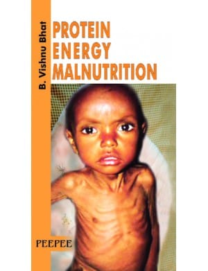 Protein Energy Malnutrition 1st Edition 2008 By Bhat