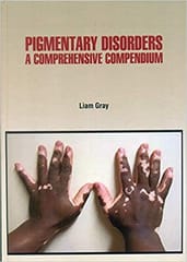 Gray L Pigmentary Disorders A Comprehensive Compendium 1st Edition 2021