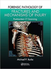 Forensic Pathology Of Fractures And Mechanisms Of Injury Postmortem Ct Scanning 2021 By Burke MP