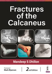 Fractures Of The Calcaneus 2nd Edition 2024 By Mandeep S Dhillon