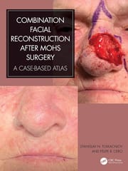Combination Facial Reconstruction After Mohs Surgery A Case Based Atlas  2024 By Tolkachjov S N