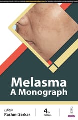 Melasma A Monograph 2024 By Rashmi Sarkar