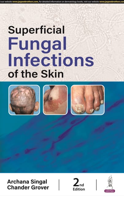 Superficial Fungal Infections Of The Skin 2nd Edition 2024 By Archana Singal