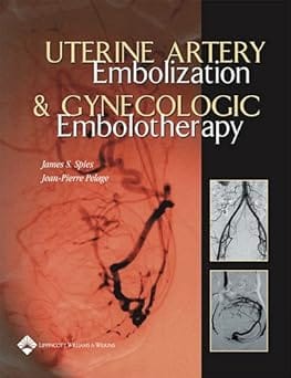 Uterine Artery Embolization & Gynecologic Embolotherapy 2005 By Spies