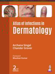 Atlas Of Infections In Dermatology 2nd Edition 2025 By Archana Singal