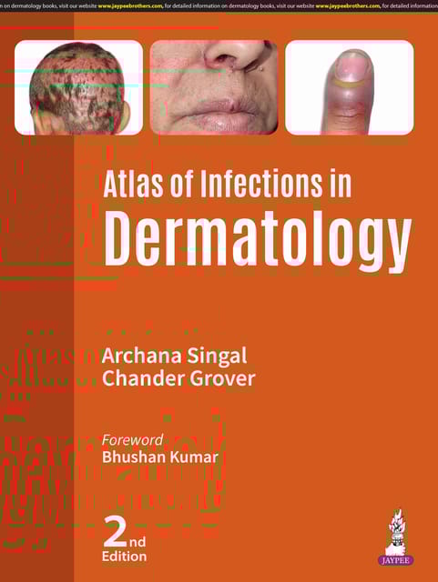 Atlas Of Infections In Dermatology 2nd Edition 2025 By Archana Singal