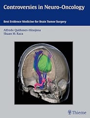 Controversies In Neuro Oncology Best Evidence Medicine For Brain Tumor Surgery 2014 By Quinones A