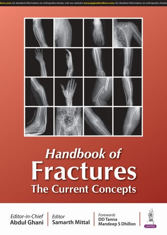 Handbook Of Fractures The Current Concepts 1st Edition 2025 By Abdul Ghani