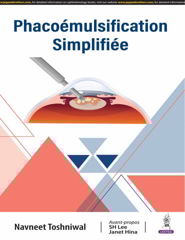 Phacoemulsification Simplifiee (French Edition) 1st Edition 2025 By Navneet Toshniwal