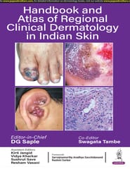 Handbook And Atlas Of Regional Clinical Dermatology In Indian Skin 1st Edition 2025 By Dg Saple