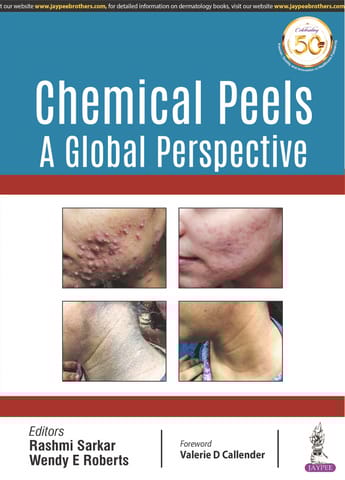 Chemical Peels: A Global Perspective 1st Reprint Edition 2025 By Rashmi Sarkar
