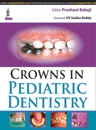 Crowns In Pediatric Dentistry 1st Reprint Edition 2025 By Prashant Babaji