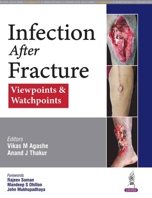Infection After Fracture : Viewpoints & Watchpoints 1st Edition 2026 By Vikas M Agashe