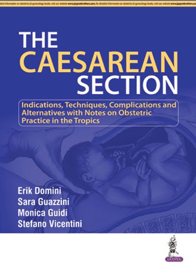 The Caesarean Seciton 1st Edition 2017 by Erik Domini
