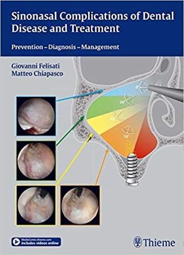 Sinonasal Complications of Dental Disease and Treatment: Prevention Diagnosis Management By Felisati