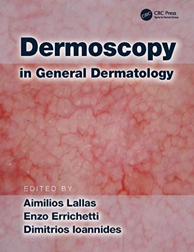 Dermoscopy in General Dermatology 2018 By Aimilios Lallas
